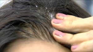 Dermatologistas dão dicas para evitar a queda de cabelo